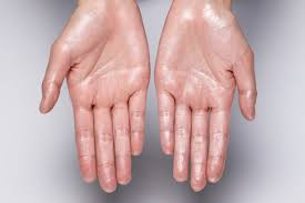 Hyperhydrosis (excessive sweating)