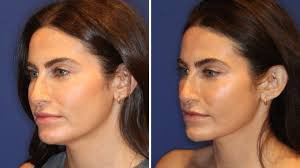 Nifertiti face lift