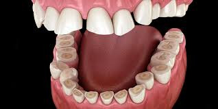 Bruxism (teeth grinding)