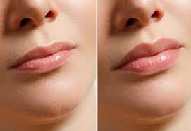 Lip Augmentation (1ml)