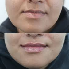 Facial Fillers (1ml)