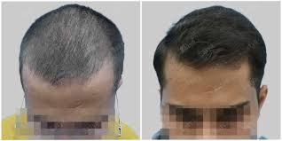 PRP hair loss 1 session