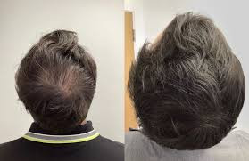 PRP Hair Restoration 3 sessions