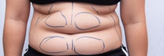 Lipolab large area (lower/upper stomach)