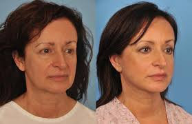 Lower face and Neck