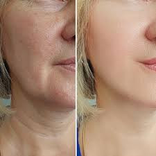 Lower face (cheeks, jawline and chin)