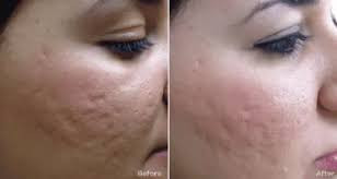 PRP Face 6 sessions